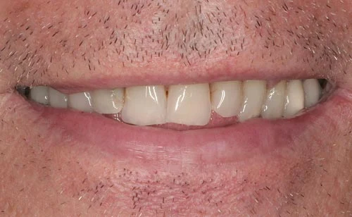 porcelain veneers san francisco are best natural 1 best porcelain veneers san francisco are natural 1