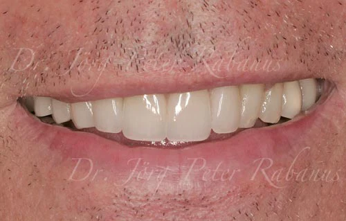 porcelain veneers san francisco are best natural 2a best porcelain veneers san francisco are natural 2a