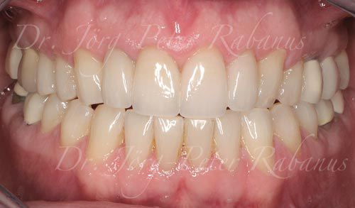 porcelain veneers san francisco are best natural 4a best porcelain veneers san francisco are natural 4a