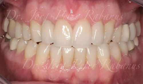 best porcelain veneers san francisco are natural 4a