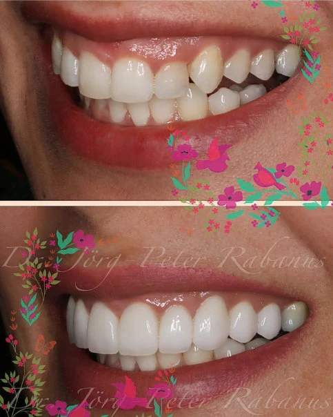 veneers in san francisco