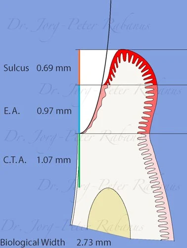 biological width with porcelain veneers