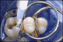 teeth bonding procedure