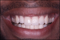 broken teeth repaired with cosmetic fiber glass post
