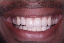 after cosmetic dentistry