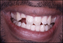 broken teeth
