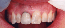 before porcelain crown