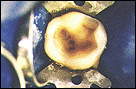 porcelain crown procedure 1