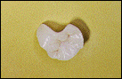 porcelain crown procedure 2