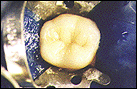 porcelain crown procedure 3