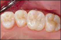 after porcelain crown placement