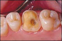 before porcelain crown placement