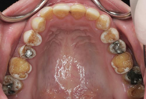 Amelogenesis Imperfecta defective enamel upper teeth