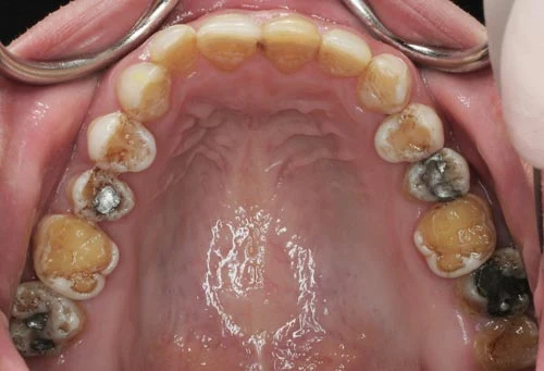 defective enamel upper teeth