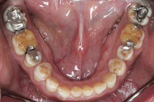 Amelogenesis Imperfecta defective enamel lower teeth
