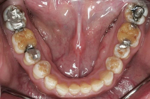 defective enamel lower teeth