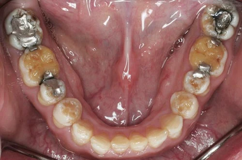 Amelogenesis Imperfecta defective enamel lower teeth