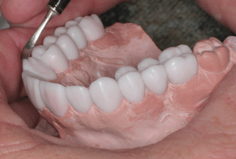 Smile Design with Diagnostic Wax-Up