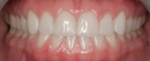 After smile makeover with porcelain laminates after smile makeover