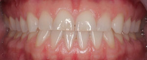 Before smile makeover with porcelain laminates before smile makeover