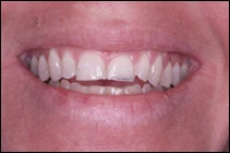 tooth erosions