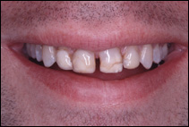 before treatment by cosmetic dentist