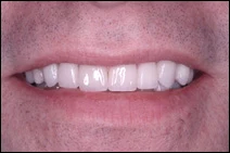 after porcelain veneers