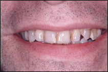 before porcelain veneers