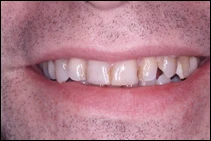 before porcelain veneers