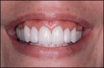 straightened teeth after cosmetic dentist