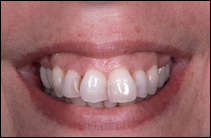 misaligned teeth before cosmetic dentist