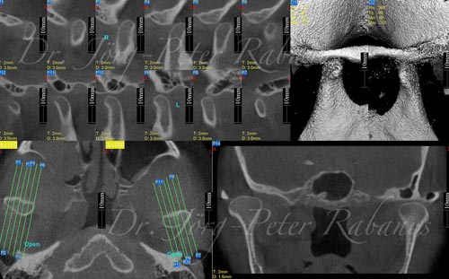 Temporomandibular Joint Position temporomandibular joint positioning