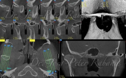 temporomandibular joint positioning