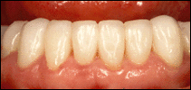 straighter teeth in cosmetic dentistry