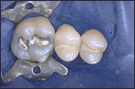 cosmetic dental fillings in san francisco