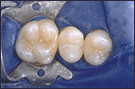 cosmetic dental final layer