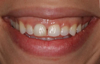 natural veneers in san francisco before procedures