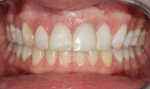Dental Condition prior to Smile Makeover with Porcelain Veneers on Dental Implant before-smile-design-with-porcelain-veneers-on-dental-implant