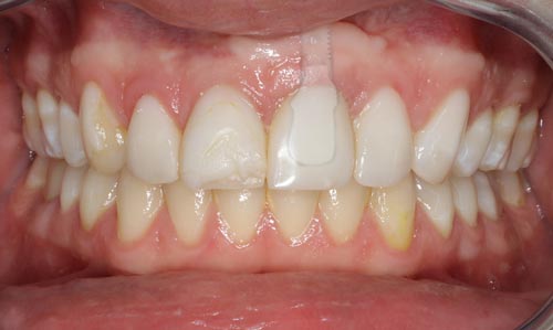Porcelain Veneers Dental Implant Before Treatment porcelain-veneers-and-dental-implant-before