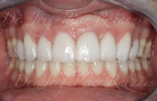 after-smile-design-with-porcelain-veneers-on-dental-implant