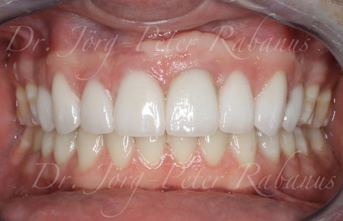 Dental Condition after Smile Makeover with Porcelain Veneers on Dental Implant after-smile-design-with-porcelain-veneers-on-dental-implant