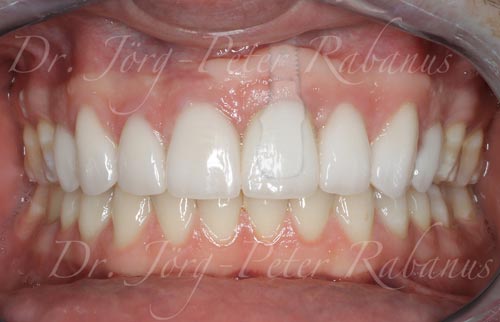 Porcelain Veneers Dental Implant After Treatment porcelain-veneers-and-dental-implant-after
