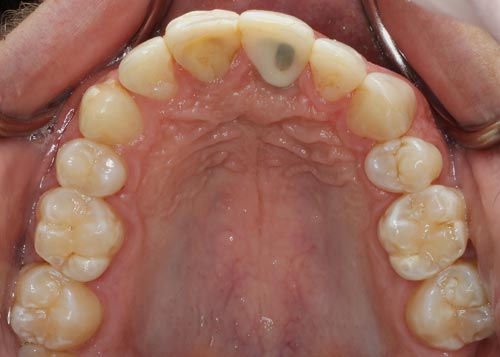 Occlusal view of smile-porcelain-veneers-and-dental-implant-before
