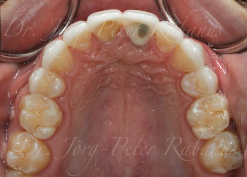 occlusal-view-of-porcelain-veneers-and-dental-implant-after