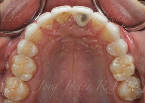 Occlusal View After Porcelain Veneers On Dental Implant occlusal-view-of-porcelain-veneers-and-dental-implant-after