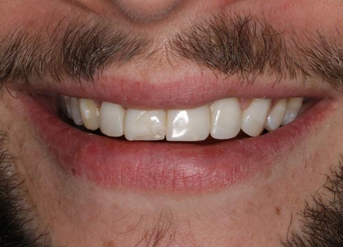 smile-porcelain-veneers-and-dental-implant-before