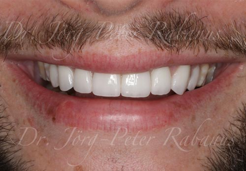 New Smile with Dental Laminates and Implant Restoration new-smile-with-dental-laminates-and-implant-tooth