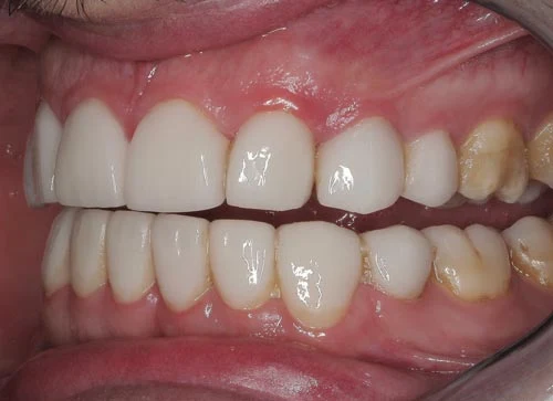 biological width violation after porcelain veneer placement