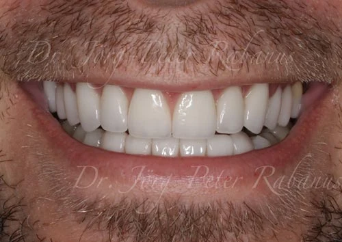 porcelain veneers for worn teeth