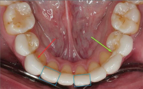 dental veneers made abroad